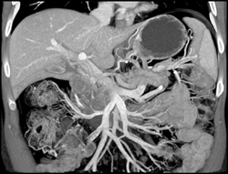 Patent PV/Superior Mesenteric Vein (SMV)/splenic Vein - CTisus CT Scan