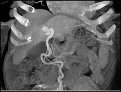 Recanalized Umbilical Vein - Liver Case Studies - CTisus CT Scanning