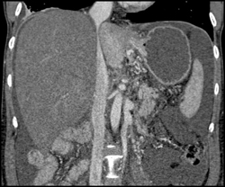 Budd-Chiari With Narrowed IVC - CTisus CT Scan