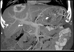 Hemangioma - CTisus CT Scan