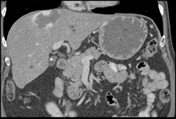 Hemangioma - CTisus CT Scan