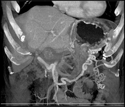 Cirrhosis - CTisus CT Scan