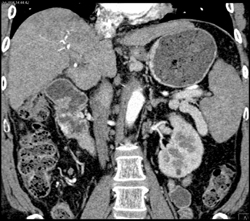 Subtle Hepatoma - CTisus CT Scan