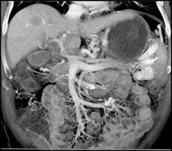 Hepatoma - CTisus CT Scan