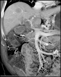 Hepatoma - See Neovascularity on Arterial Phase - CTisus CT Scan