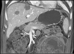 Post Radiofrequency Ablation (RFA) Changes - CTisus CT Scan