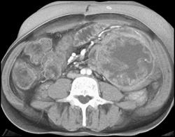 Rf Changes Liver With Retained Towel (oops!) in Left Lower Quadrant - CTisus CT Scan