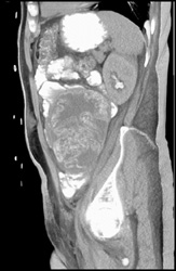 Rf Changes Liver With Retained Towel in Left Lower Quadrant - CTisus CT Scan