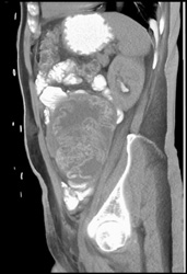 Retained Towel in Left Lower Quadrant - CTisus CT Scan