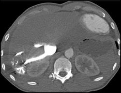 Reflux of Contrast Into IVC and Hepatic Veins - CTisus CT Scan