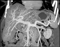 Cirrhosis - CTisus CT Scan