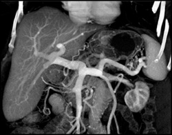 Cirrhosis - CTisus CT Scan