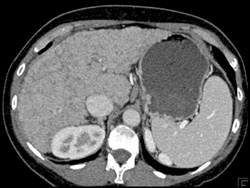 Hepatoma in A Cirrhotic Liver - CTisus CT Scan