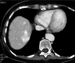 Hemangioma - CTisus CT Scan