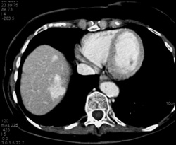 Hemangioma - CTisus CT Scan