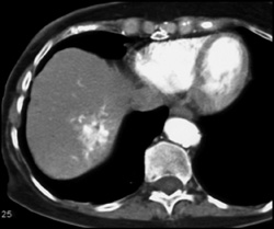 Hemangioma - CTisus CT Scan