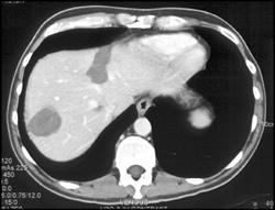 Post Radiofrequency Ablation (RFA) - CTisus CT Scan