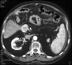 Recurrent Islet Cell Tumor With Liver Metastases - CTisus CT Scan