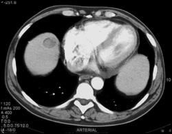 Hepatoma - Liver Case Studies - CTisus CT Scanning