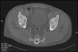 Hematopoiesis Due to Hemochromatosis of the Liver - CTisus CT Scan