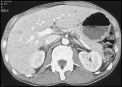 Liver Abscess - CTisus CT Scan