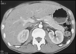 Liver Abscess - CTisus CT Scan