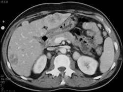 Carcinomatosis With Liver Metastases - CTisus CT Scan