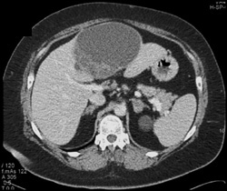 Biliary Cystadenocarcinoma - CTisus CT Scan