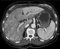 Hepatic Congestion - CTisus CT Scan