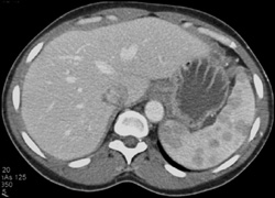 Splenic Lymphoma and Normal Liver - CTisus CT Scan