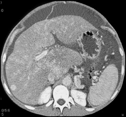 Regenerating Nodules and Budd-Chiari Syndrome - CTisus CT Scan