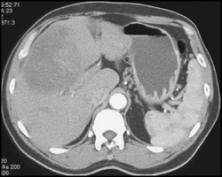 Hepatoma - CTisus CT Scan