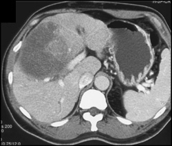 Hepatoma - CTisus CT Scan