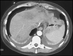 Fatty Liver - CTisus CT Scan