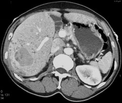 Liver Metastases - CTisus CT Scan