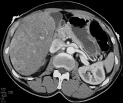 Liver Metastases - CTisus CT Scan