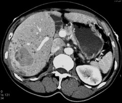 Liver Metastases - CTisus CT Scan