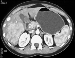 Hepatoma - CTisus CT Scan