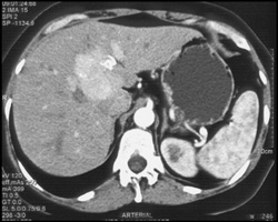 Focal Nodular Hyperplasia - CTisus CT Scan