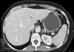 Focal Nodular Hyperplasia - CTisus CT Scan