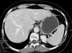 Focal Nodular Hyperplasia - CTisus CT Scan