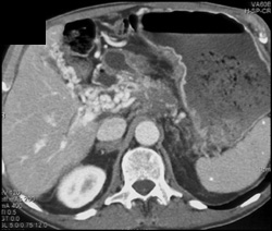 Cavernous Transformation of the Portal Vein - CTisus CT Scan