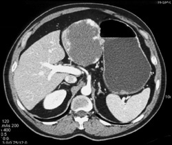 Hemangioma - CTisus CT Scan