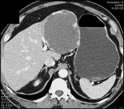 Hemangioma - CTisus CT Scan