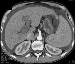 Cirrhosis With Portal Vein Thrombosis (PVT) - CTisus CT Scan