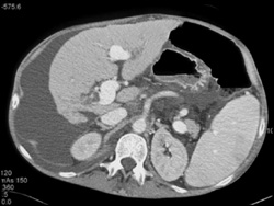 Cirrhosis - CTisus CT Scan