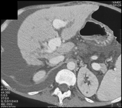 Cirrhosis With Small Cholangiocarcinoma in the Right Lobe - CTisus CT Scan