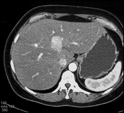 Focal Nodular Hyperplasia (FNH) - CTisus CT Scan