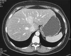 Focal Nodular Hyperplasia (FNH) - CTisus CT Scan