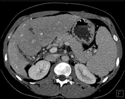 Cirrhosis - CTisus CT Scan